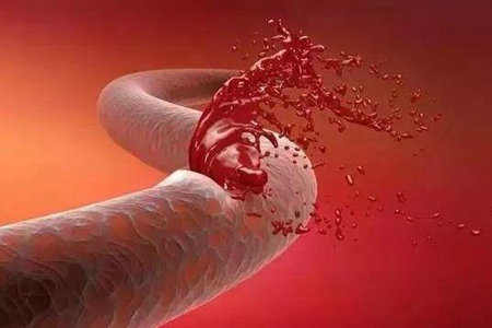 脑出血是怎么引起的？这四个诱发脑出血症状及表现