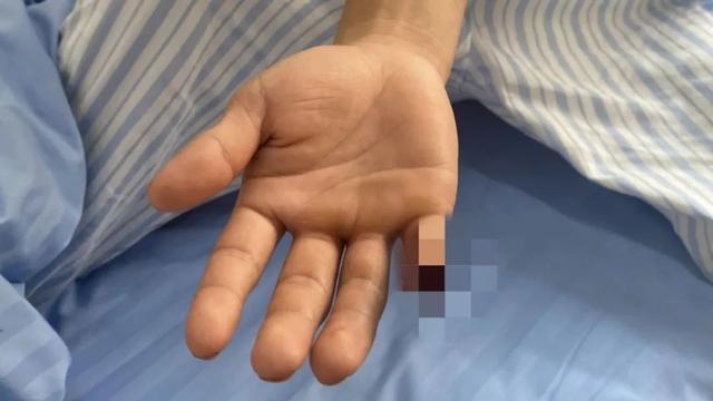 云南辅警抓偷渡蛇头被咬断手指