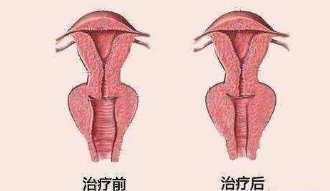 阴道松弛怎么办 有效的缩阴锻炼方法有哪些？