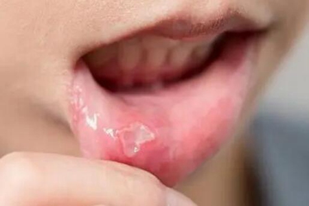 口腔溃疡怎么快速好？这三个缓解疼痛症状的方法