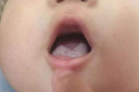 婴儿舌苔厚白是怎么回事？这四个原因引发得及时调理
