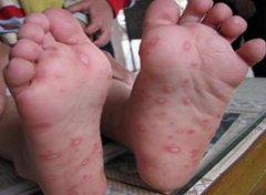手足口病症状