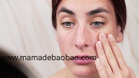 3种方法来去除鼻子上的黑头p站（使用家庭小偏方）